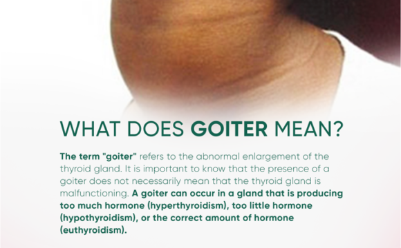 The goiter and everything you should know about it